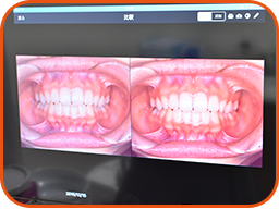 口腔内の撮影