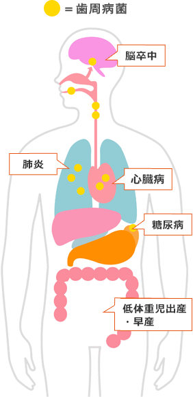 歯周病と全身疾患との関連図