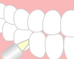 歯石の除去