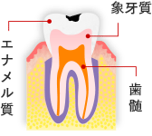 C1 軽度のむし歯