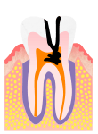 C3 重度のむし歯