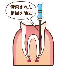 根管治療の流れ 2