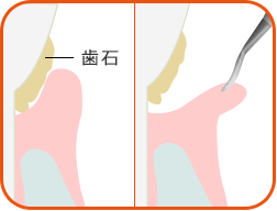 歯周外科