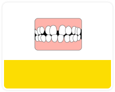 歯と歯の間に隙間がある（すきっ歯）