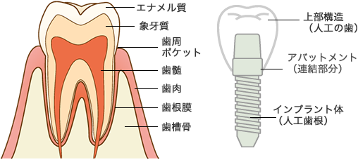 インプラント治療とは？