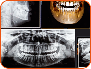 歯科用CTを使用した正確な診断